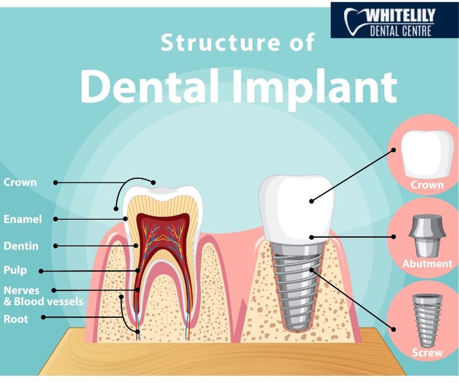 Dental Implant Service